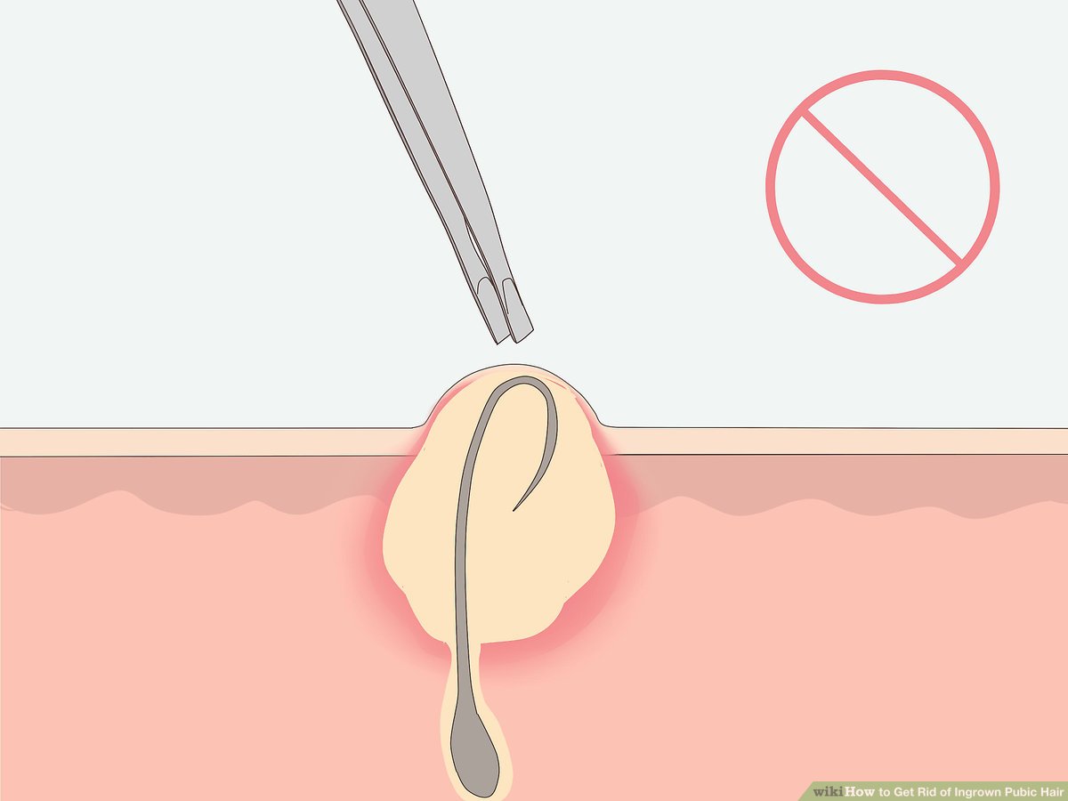 How to Remove Ingrown Hairs on Genitals and Heal Lumps How to Remove Ingrown Hairs on Genitals and Heal Lumps